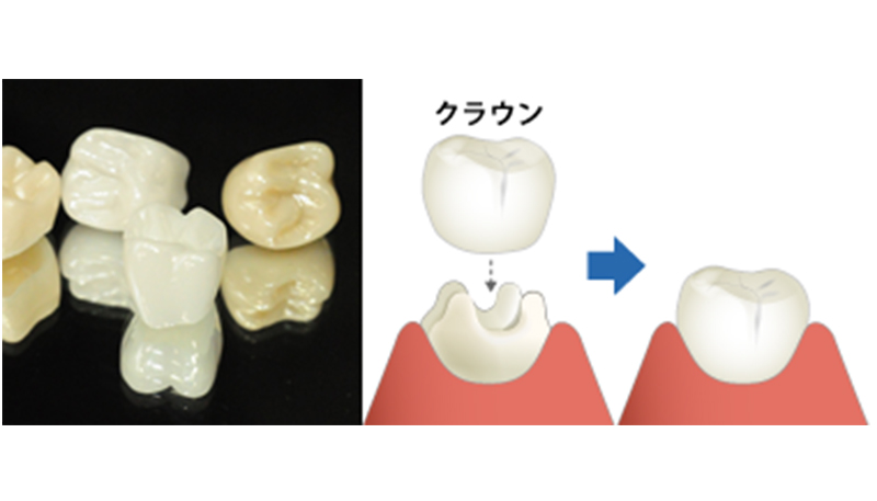 ☆DVD付き『 ナノジルコニアを活かしたオールセラミック修復 新たなメタルフリー修復の時代 』三浦宏之 宮崎隆 ほか編著 医歯薬出版 B2-4 セラミックス | 世田谷区桜新町の歯科医院 東京医科歯科大学教授の
